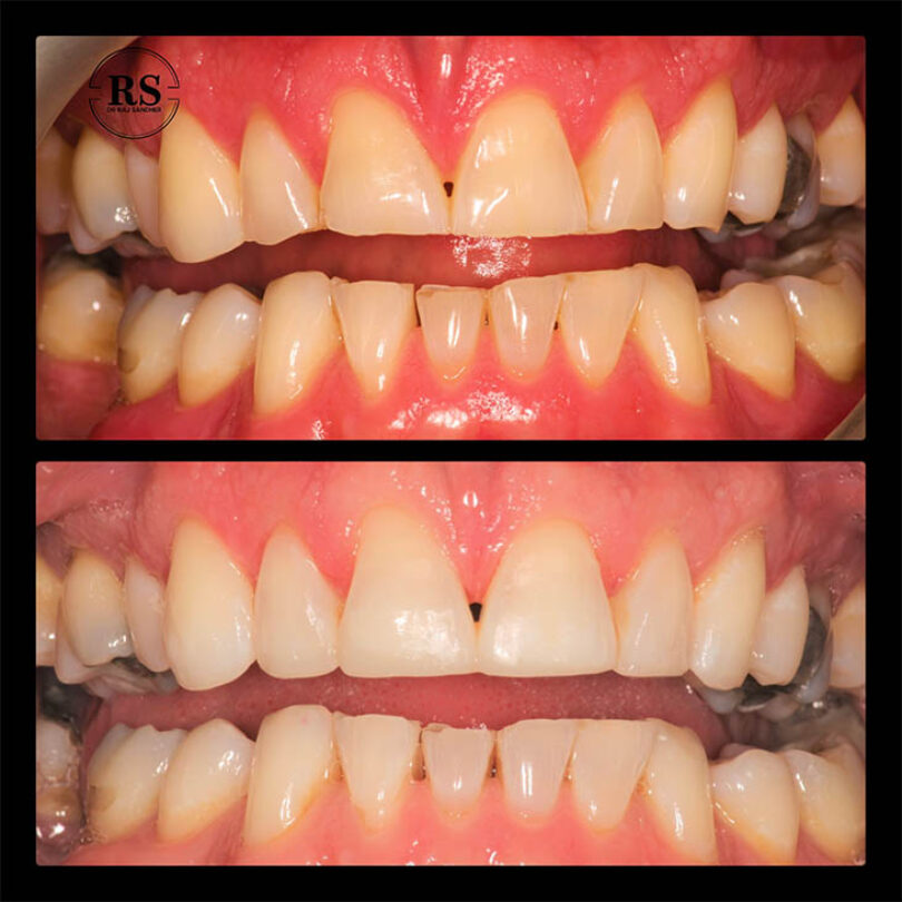 Before After - Earley Dental