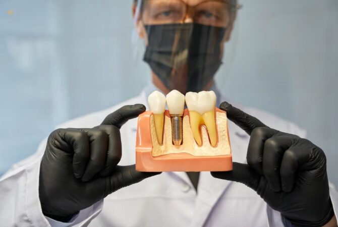 Dental Implants in Reading - Earley dental